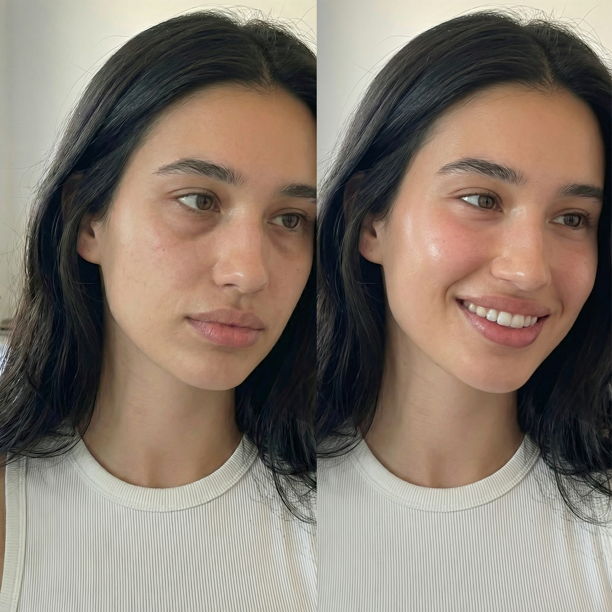 Gouttières Somnicare